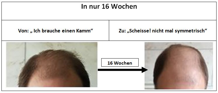 In 16 Wochen Haare weg - Glatze